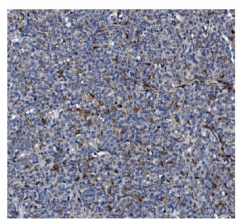IHC staining of FFPE human lymph node tissue with GSDMD antibody. HIER: boil tissue sections in pH8 EDTA for 20 min and allow to cool before testing.