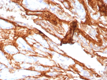 IHC staining of FFPE human prostate carcinoma tissue with Decorin antibody (clone DCN/8760R). HIER: boil tissue sections in pH 9 10mM Tris with 1mM EDTA for 20 min and allow to cool before testing.