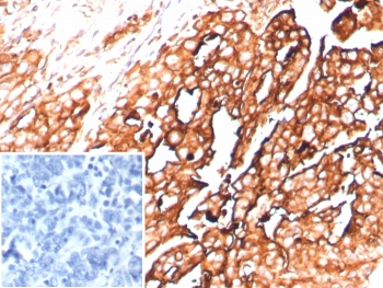 IHC staining of FFPE human ovarian cancer tissue with recombinant MSLN antibody (clone rMSLN/8764). Inset: PBS used in place of primary Ab (secondary Ab negative control). HIER: boil tissue sections in pH 9 10mM Tris with 1mM EDTA for 20 min and allow to cool before testing.