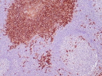 IHC staining of FFPE human tonsil tissue with CD138 antibody (clone SDC1/7177). HIER: boil tissue sections in pH 9 10mM Tris with 1mM EDTA for 20 min and allow to cool before testing.