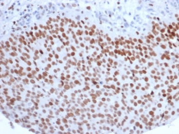 IHC staining of FFPE human bladder carcinoma with Enhancer of zeste homolog 2 antibody (clone EZH2/6988). HIER: boil tissue sections in pH 9 10mM Tris with 1mM EDTA for 20 min and allow to cool before testing.