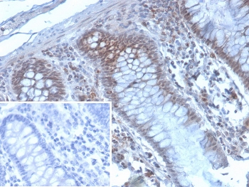 IHC staining of FFPE human colon carcinoma tissue with KMT6 antibody (clone EZH2/4194). Inset: PBS used in place of primary Ab (secondary Ab negative control). HIER: boil tissue sections in pH 9 10mM Tris with 1mM EDTA for 20 min and allow to cool before testing.