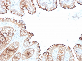 IHC staining of FFPE human colon carcinoma with Villin antibody cocktail (clones VIL1/1314 + VIL1/2376). HIER: boil tissue sections in pH 9 10mM Tris with 1mM EDTA for 20 min and allow to cool before testing.